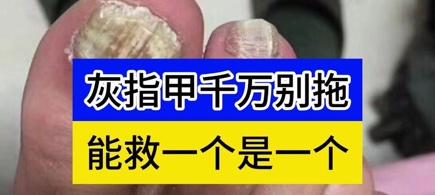 有效消灭真菌的方法有哪些？如何彻底清除真菌？